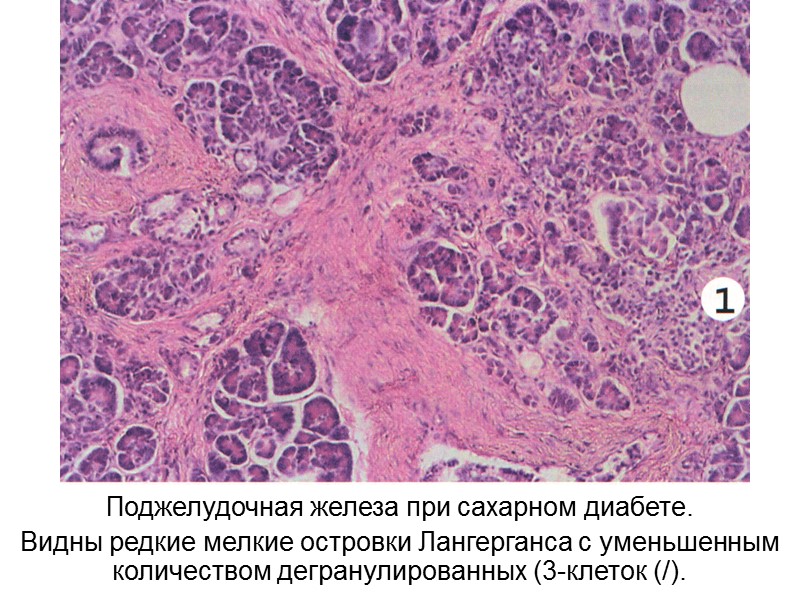 Поджелудочная железа при сахарном диабете. Видны редкие мелкие островки Лангерганса с уменьшенным количеством дегранулированных